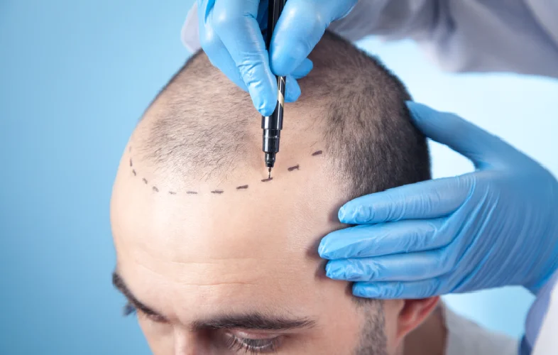 Choosing the Right Hair Transplant Surgeon