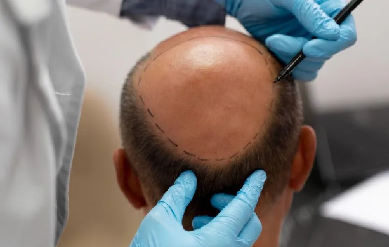 Understanding Hair Transplant: Its Benefits, Procedures, and What to Expect