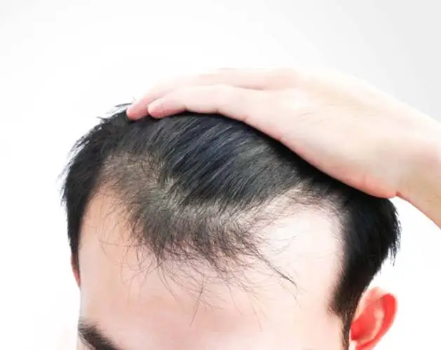 There are two advances methods for hair transplant FUE hair transplant in Gurgaon and FUT hair Transplant SB Trichology gives you the perfect hair transplant at an affordable cost.