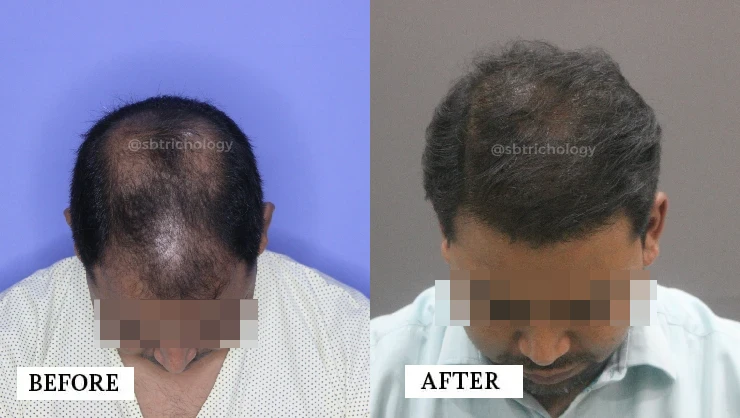 hair transplant before and after 