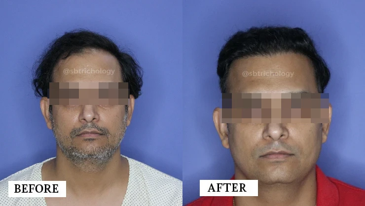 hair transplant before after 