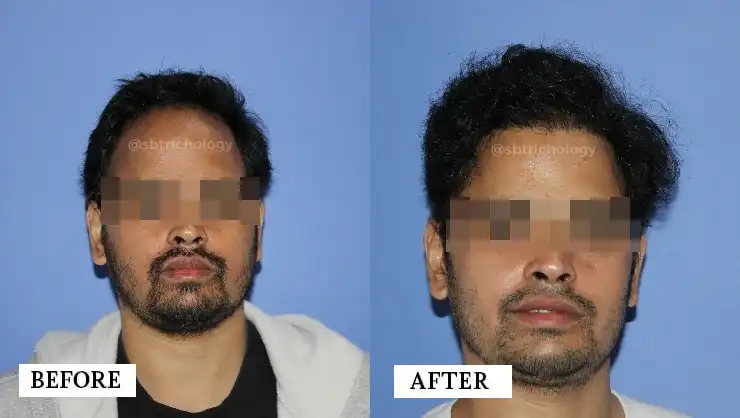 hair transplant images before and after​