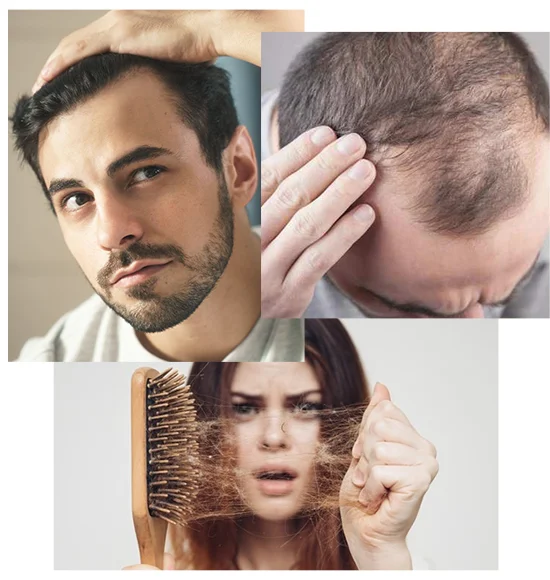 Get the best hair transplant in Gurgaon at SB Trichology. Check out the cost and procedure with the best Hair Transplant Surgeon in Gurgaon.